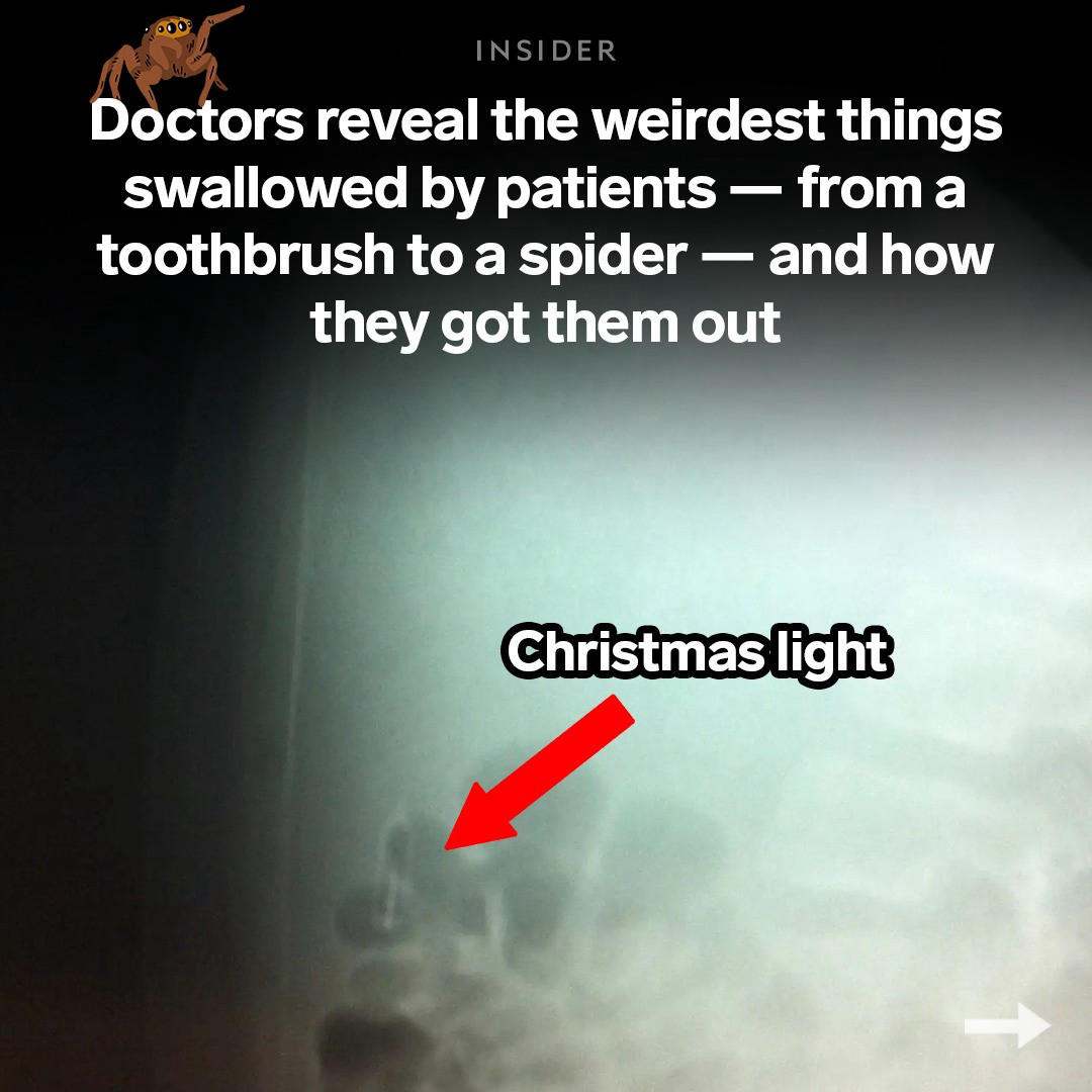 Science Insider - Emergency physicians have found a range of strange objects inside their patients